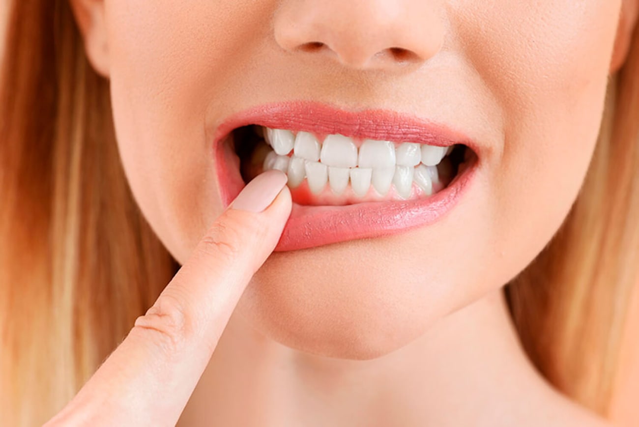 gingivitis aguda
